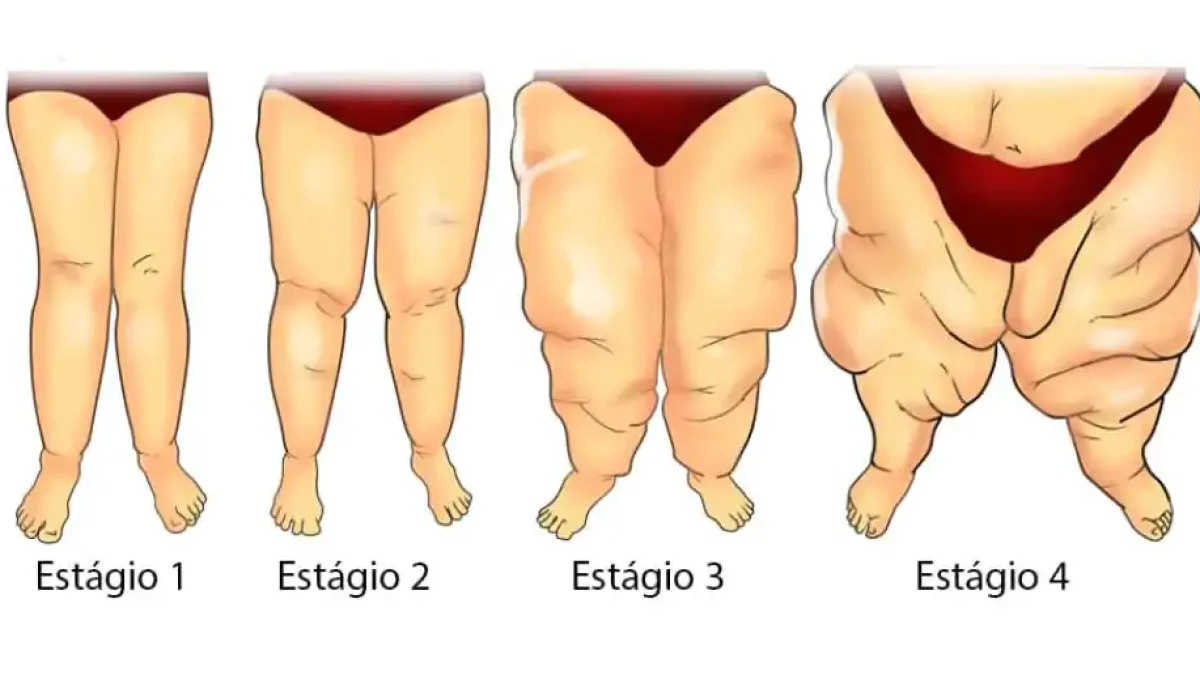Acúmulo de gordura nas pernas e braços pode ser sinal de doença vascular -  Way Comunicações