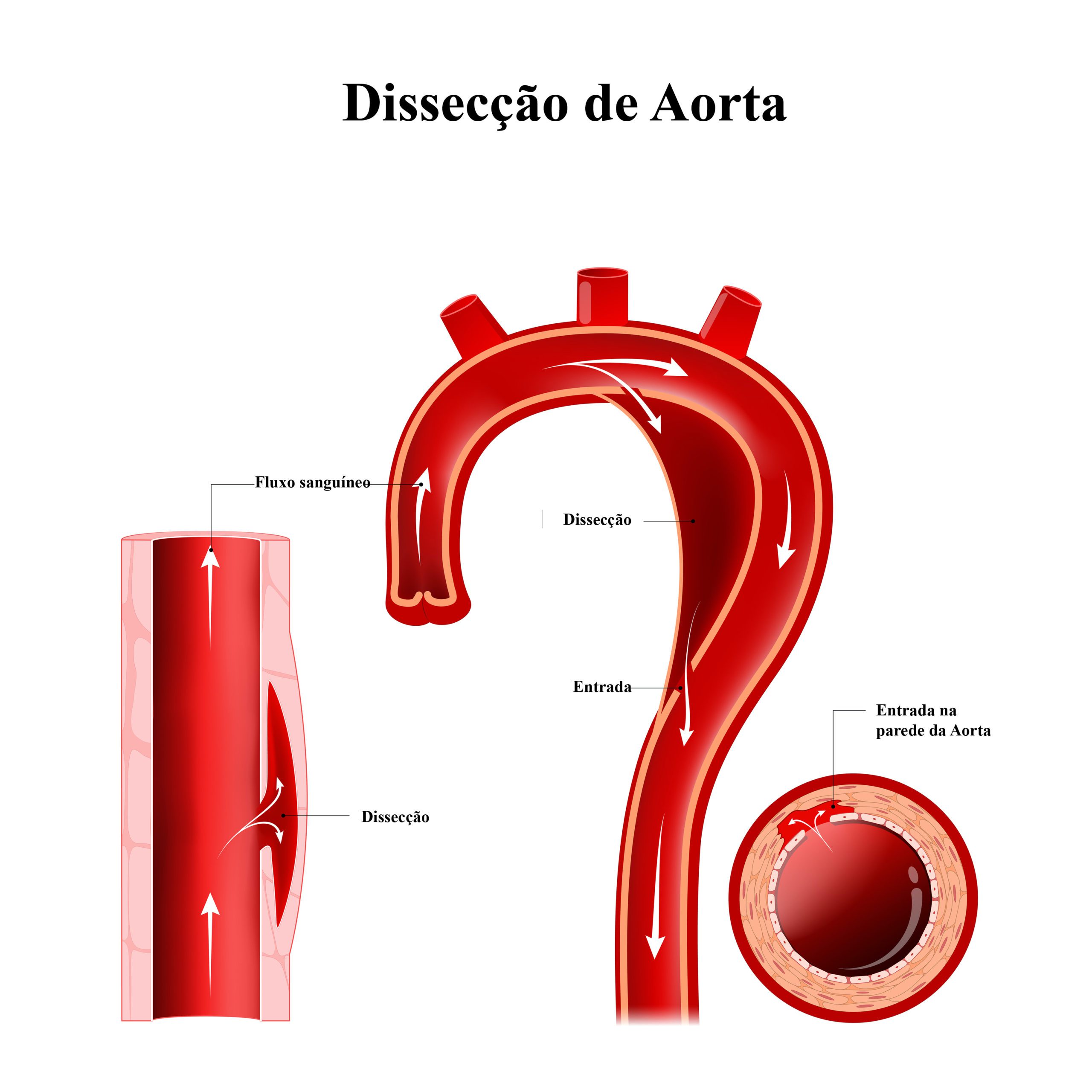 Jornal do Médico: Dissecção de Aorta representa risco de vida e exige um diagnóstico adequado