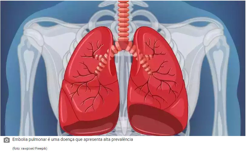 <strong>O Estado de Minas: Embolia Pulmonar – sintomas leves podem ser confundidos com outras doenças</strong>