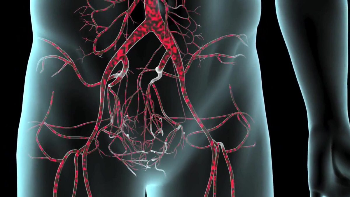 Portal Drauzio Varella: Aneurisma da Aorta Abdominal – Causas, Diagnóstico e Tratamento